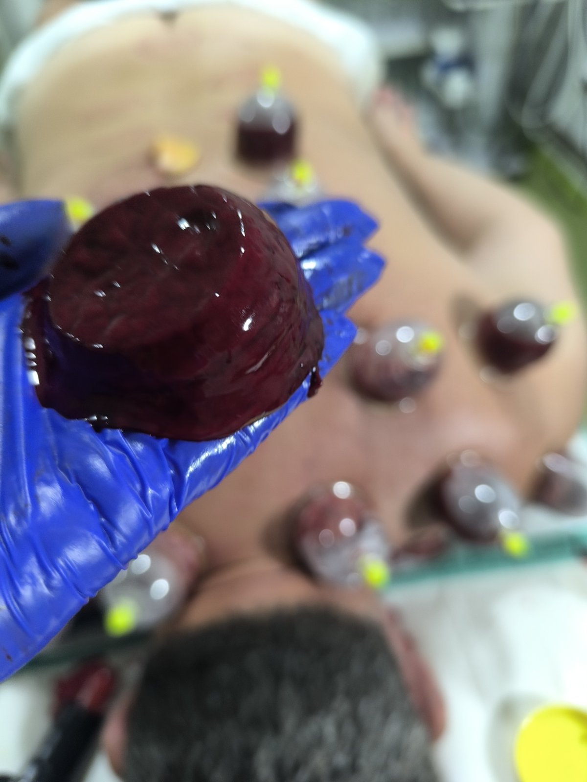 Vacuum Cupping